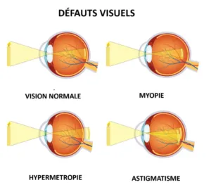 defauts visuels